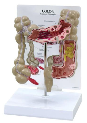 Modelo AnatÃ´mico de CÃ³lon com Patologias