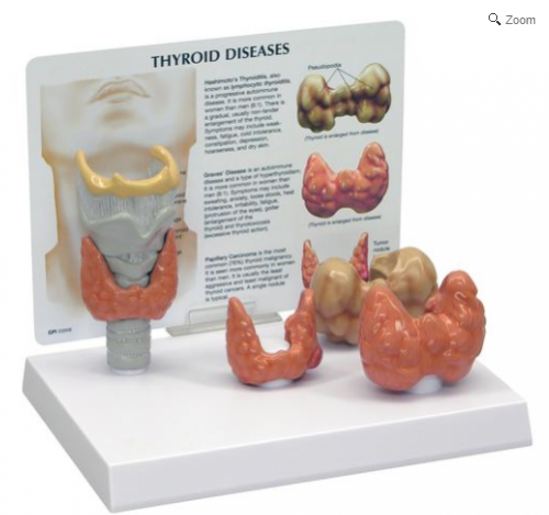 Modelo AnatÃ´mico de TireÃ³ide com Patologia