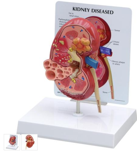 Modelo de Rim com GlÃ¢ndula Adrenal