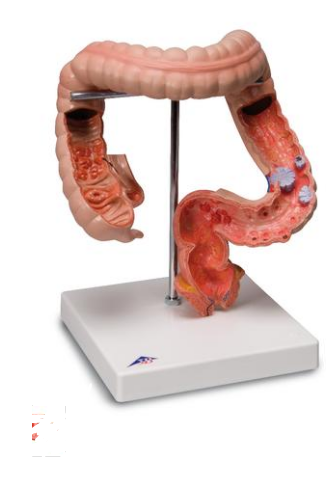 Modelo AnatÃ´mico de Patologias Intestinais